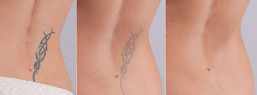 Dreiteiliges Vorher-Nachher-Bild einer Tattooentfernung in Düsseldorf an der Körperseite mit deutlichem Rückgang des Tattoos nach mehreren Sitzungen