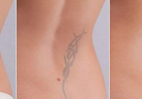 Tattooentfernung im Test: Methoden, Kosten, Ergebnisse