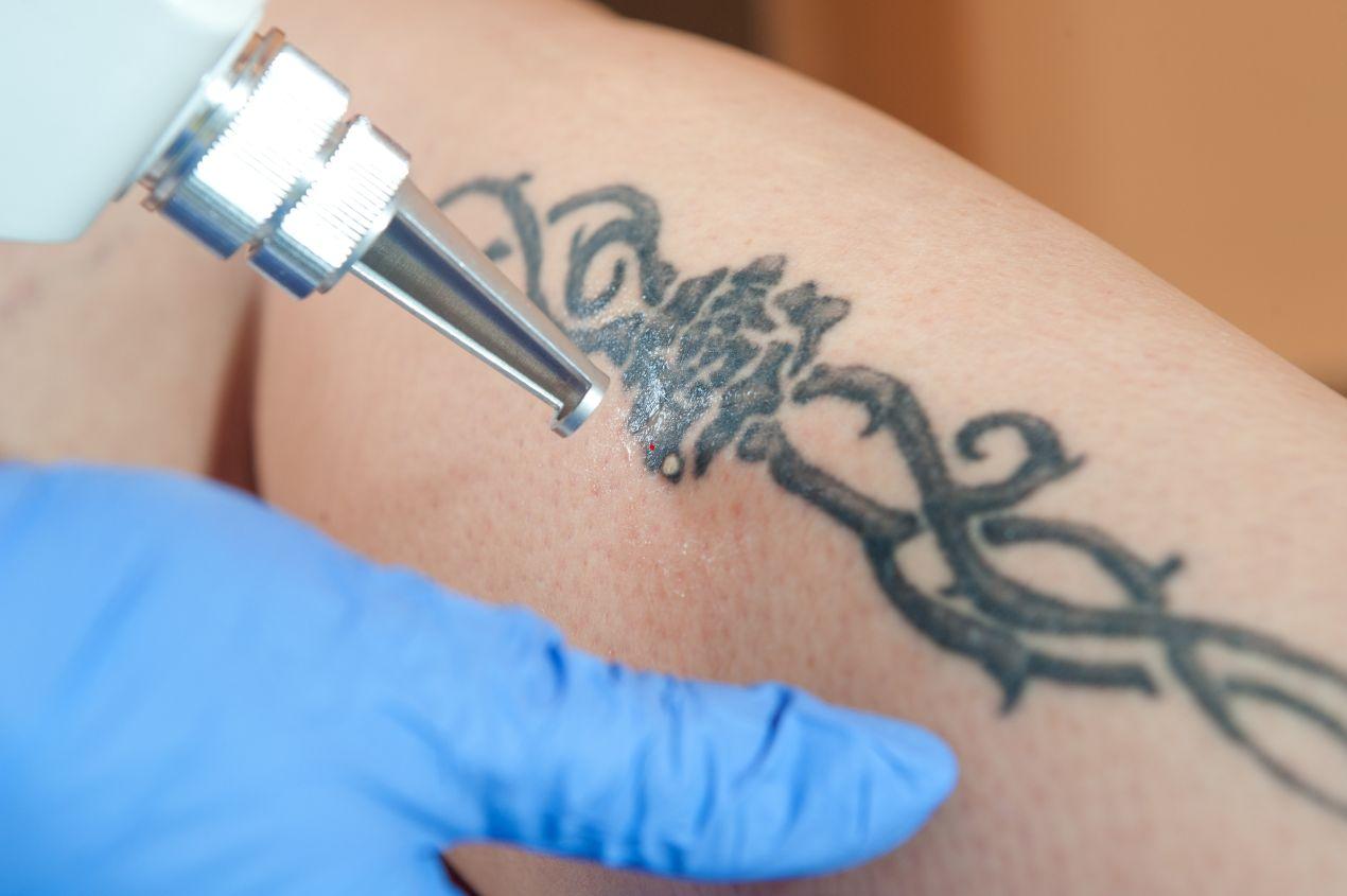 Laserbehandlung zur Tattooentfernung Düsseldorf an der Wade mit blauem Handschuh und schwarzem Tribal-Motiv auf der Haut
