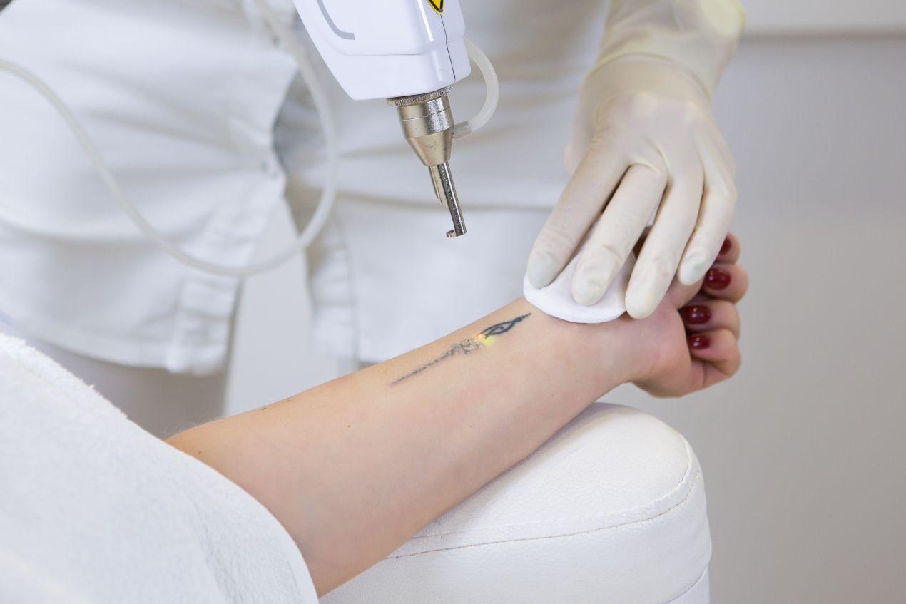 Tattooentfernung Düsseldorf mit moderner Lasertechnologie am Handgelenk durch Fachkraft in weißer Kleidung mit Handschuhen